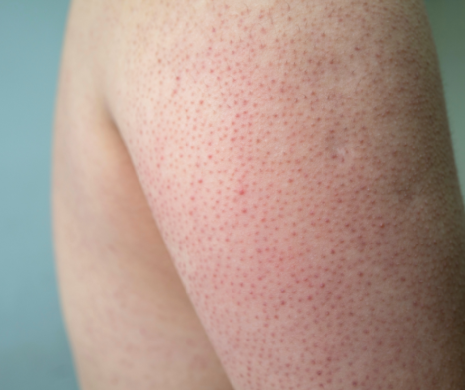 Afbeelding keratosis pilaris