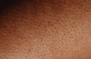 keratosis pilaris