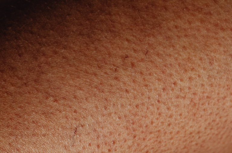 keratosis pilaris