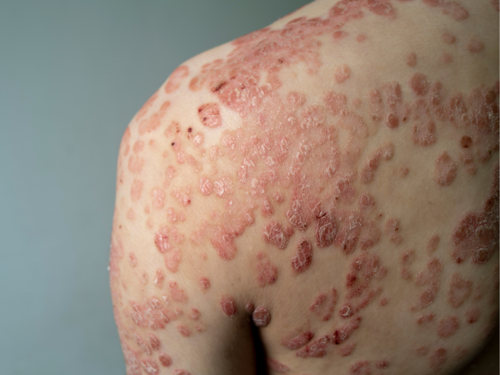 psoriasis pakkaten schouder
