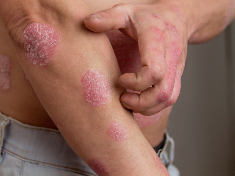 Psoriasis armen