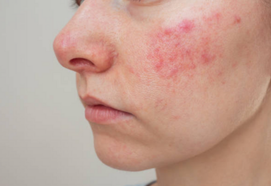 Afbeelding rosacea op de huid roodheid